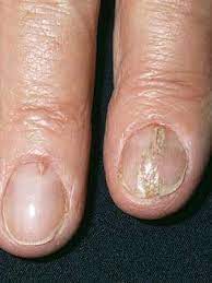 what are the white spots on your nails