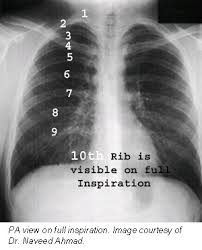 Check spelling or type a new query. Good Positioning Is Key To Pa Chest X Ray Exams