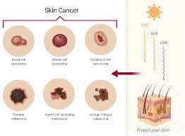 skin cancer issues caused by