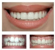teeth bonding a fast and way to