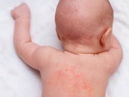 rashes in children chandigarh ayurved