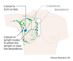 Stage 2 Breast Cancer Cancer Research Uk