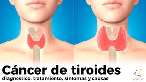 The isthmus, a thin piece of tissue, connects the two lobes.a healthy thyroid is a little larger than a quarter. Cancer De Tiroides Diagnostico Tratamiento Sintomas Causas Youtube