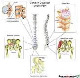 Image result for icd 10 code for bilateral sciatica pain