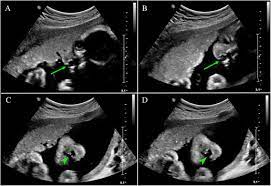 transabdominal ultrasonography of case