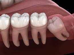 wisdom teeth removal deerfoot dental