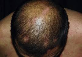 acneiform eruption alopecia areata