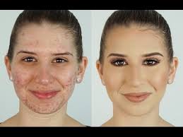 conceal acne heidi hamoud
