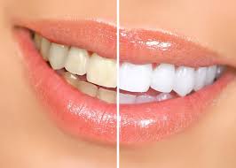 why zoom professional teeth whitening