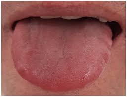 microbiota of the tongue