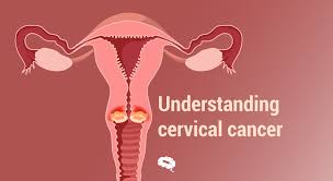 understanding cervical cancer causes