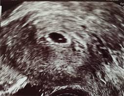 Der embryo ist auf dem ultraschall zu dieser zeit oft noch nicht zu erkennen. Ultraschallbilder Mehr Als 50 Bilder Aus Der Schwangerschaft Faminino