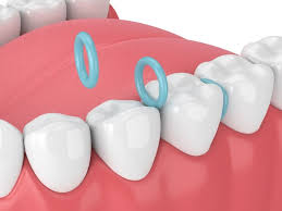 Oral anesthetics a simple way to get some braces pain relief is to rub an oral anesthetic like orajel or anbesol directly on the sensitive teeth and gums. Spacers For Teeth What They Are Do Pain All You Need To Know