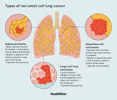 types of non small cell lung cancer