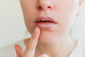 precancerous lip lesions early se