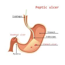 peptic ulcer gastritis singapore
