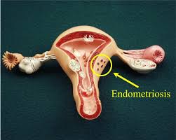 While this disease can be draining and painful, both physically and emotionally, it doesn't define you. Endometriosis