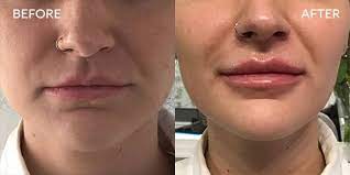 lip fillers london from 111 harley st