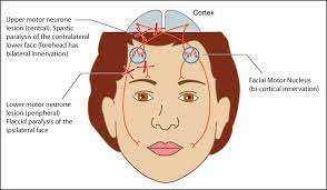 cranial nerve vii palsy 7 4