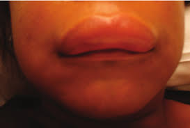 angiodema confined to the upper lip