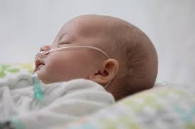 Neonatal Guidelines And Best Practices Vapotherm Mask
