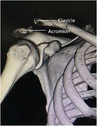 Classification three distinct types of acromions were identified type i flat (17.1%) angle of anterior slope: To Explore The Reasonable Selection Of Clavicular Hook Plate To Reduce The Occurrence Of Subacromial Impingement Syndrome After Operation Journal Of Orthopaedic Surgery And Research Full Text