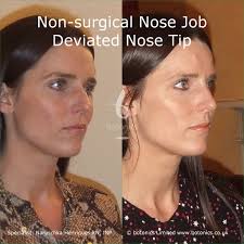 It requires no downtime so you can immediately return to your normal daily activities after your. Non Surgical Nose Job Before After Photos Comparison In London Uk