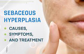 sebaceous hyperplasia causes symptoms