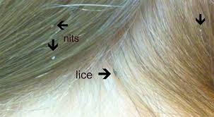 how to detect head lice treat it and