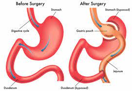 gastric byp surgery revision