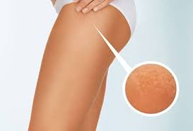 Cellulite Treatment Manchester & Bolton | Enhance Clinispa