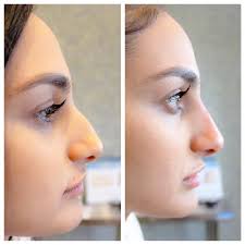 We recommend you to undergo rhinoplasty after filler is completely absorbed. Face Fillers Temporary Nose Job Before After Photos