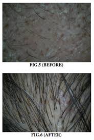 Reddish purple lines on the arms, face, legs, trunk, or groin. Imcas Academy Aesthetic Surgery Cosmetic Dermatology