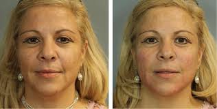 lines gone instantly with juvederm