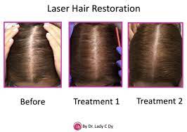 the new wave of hair restoration lasers