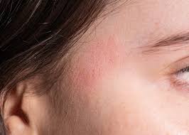 dermais eczema