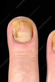 dystrophic finger nail stock image