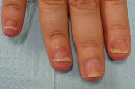 nail psoriasis dr dana stern