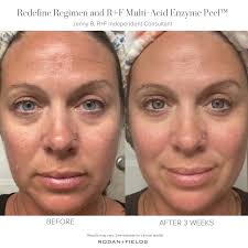 before and afters rodan fields au
