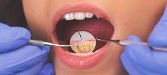 periodonis causes symptoms and 5