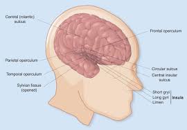 refractory insular cortex epilepsy