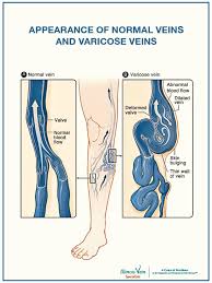 From the heart, oxygenated blood is pumped throughout the when venous insufficiency is present, varicose vein treatment is covered by most insurance plans. Does Insurance Cover Varicose Veins Treatment