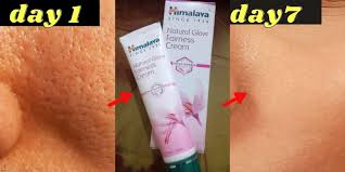 oily acne e skin with open pores