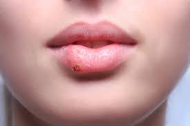 herpes lips images
