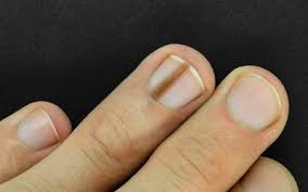 clubbed fingers and nails causes and