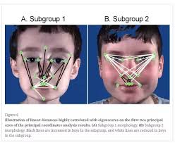 The savant syndrome and its possible relationship to epilepsy. Is Asperger S Syndrome Autism Quora
