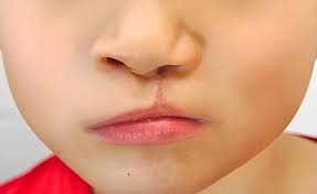 cleft lip and palate surgery what you