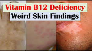 vitamin b12 deficiency weird skin