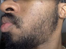 minoxidil for beard growth works