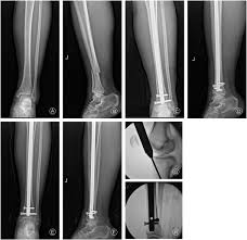 distal tibial fractures